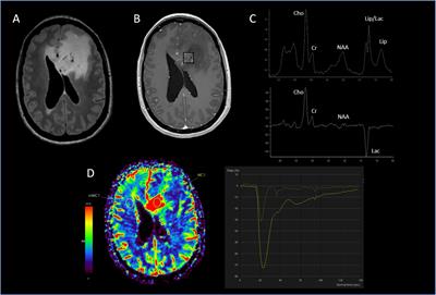 Machine learning decision tree models for multiclass classification of common malignant brain tumors using perfusion and spectroscopy MRI data